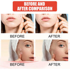 Invisible Breathable Repair Hydrogel --For Acne Patches, easy to use .